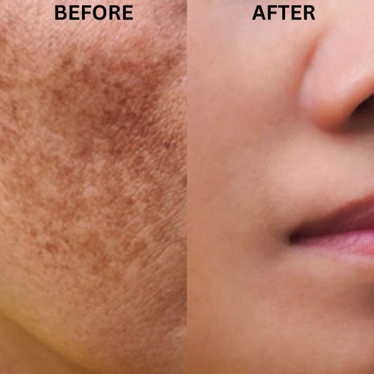 Skinera Anti Pigmentation Moisturiser 50gm (Improved)