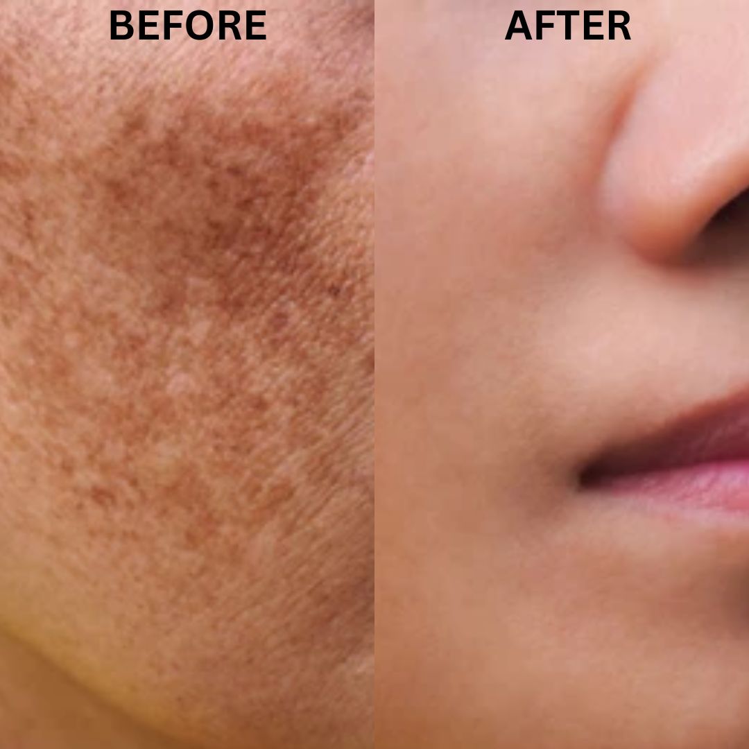 Skinera Anti Pigmentation Moisturizer 50gm