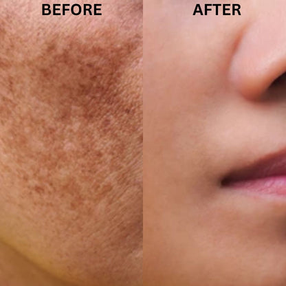 Skinera Anti Pigmentation Moisturizer 50gm